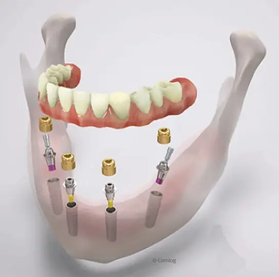 Oralchirurgie Berlin